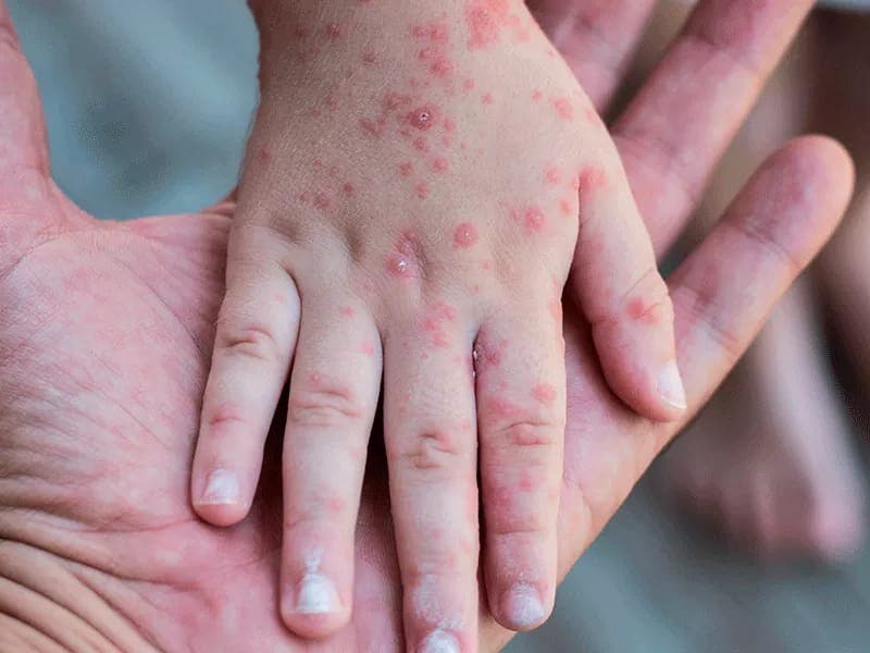 smallpox symptoms