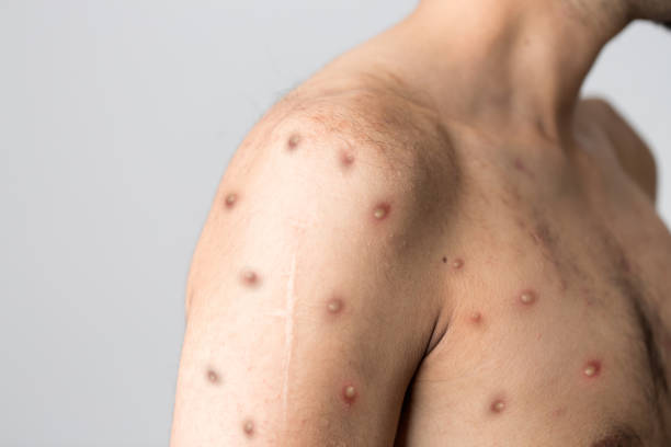 Monkeypox virus could also be transmitted by air 