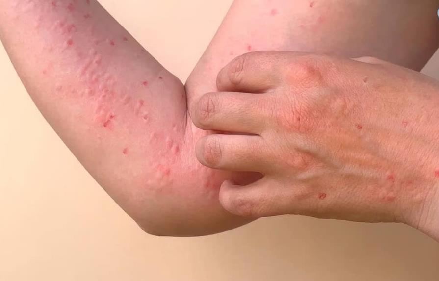 chikungunya rashes