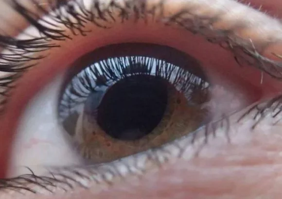 Retinitis Pigmentosa in Dominican Republic: Vision signs that should not be overlooked