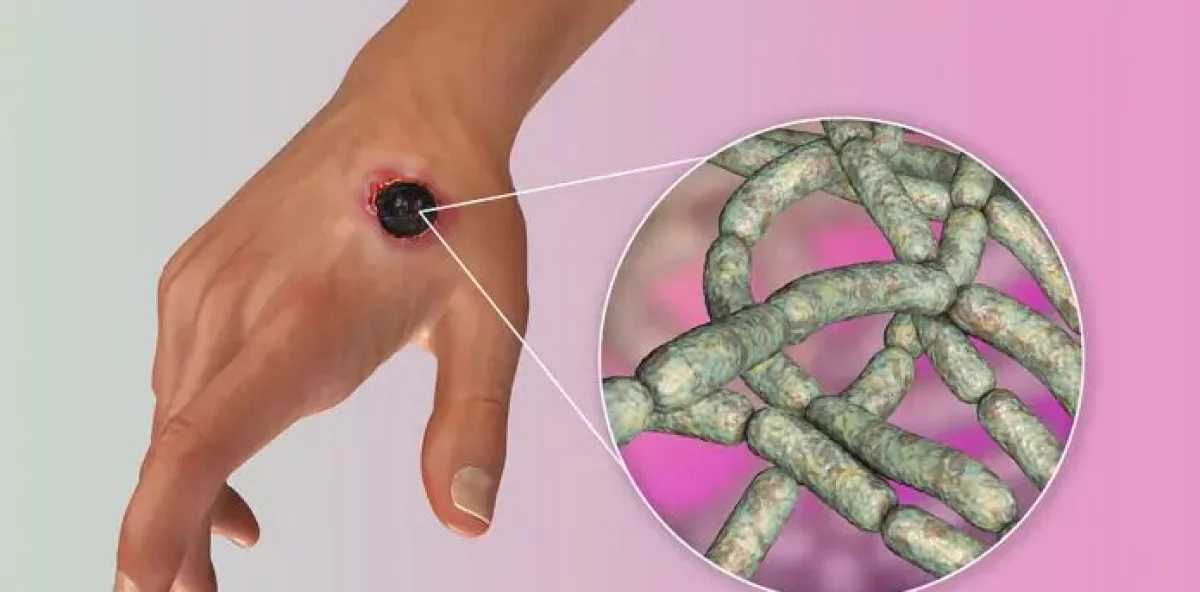 Anthrax suspicions in Haiti: Are there confirmed cases in the Dominican Republic and is there a health emergency?
